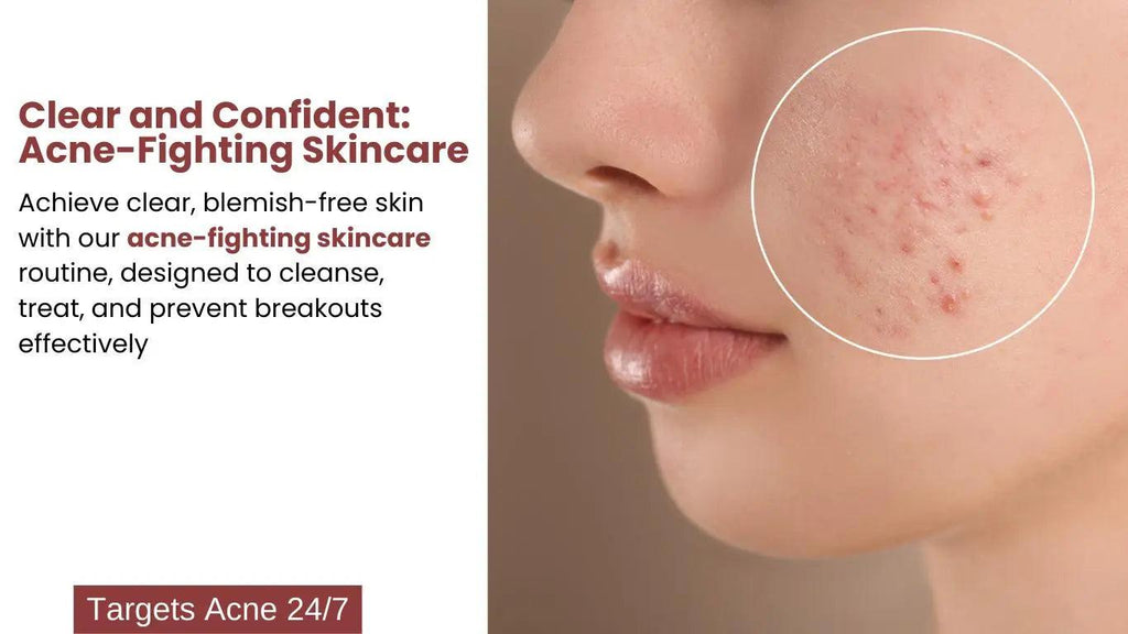 Ammuri Anti-Acne Skincare Set for Radiant Skin